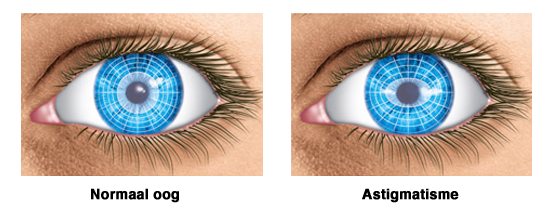 1 day acuvue moist for astigmatism